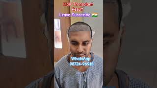 Hair Transplant India  How to grow thicker hair hair hairtransplant delhi youtubeshorts 2024 [upl. by Dominus974]