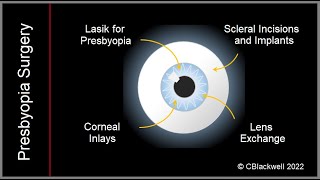 Presbyopia 3 New Treatments with Surgery [upl. by Enahpets226]