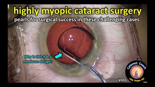 highly myopic patient having cataract surgery [upl. by Ayitahs]