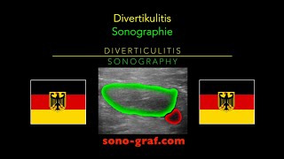 Sonographie  Divertikulitis [upl. by Gibbon]