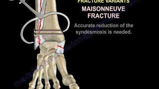 Ankle Fractures  Special Situations  Everything You Need To Know  Dr Nabil Ebraheim [upl. by Lyrac836]