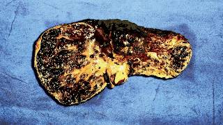 A Family Ate 1 Year Old Frozen Leftovers For Breakfast This Is What Happened To Their Organs [upl. by Waechter70]