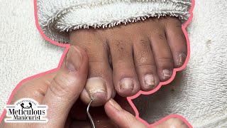 How to Trim Nails with Ingrown Toenail Discomfort and Deep Nail Grooves [upl. by Allenad]