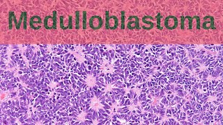 What are Medulloblastomas  Pathology mini tutorial [upl. by Yuh312]