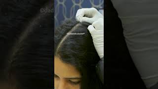 Keravive Exfo treatment for your scalp  Dadu Medical Centre [upl. by Nnairahs]