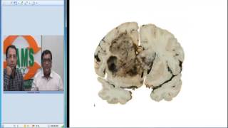 GLIOBLASTOMA MULTIFORME GBM RADIOPATH CORRELATION [upl. by Nosmirc379]