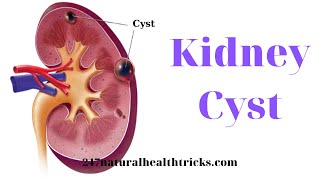 Kidney Cyst  Are cysts on kidneys life threatening  Can kidney cysts just go away  247nht [upl. by Nylra11]