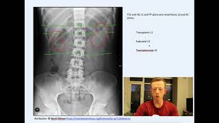 Finding kidneys on Xray using the transpyloric plane [upl. by Anglo]