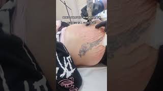 Stretch Mark Removal Process Using Inkless Camouflage Dry Needling Technique How To Remove Scars [upl. by Honorine]