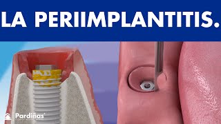 Periimplantitis  Los implantes dentales también pueden fracasar © [upl. by Ambrogino]