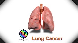 Lung Cancer  Symptom Causes amp Diagnosis Finding Earth [upl. by Ewen532]