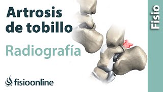 Artrosis de tobillo  Qué es y cómo se diagnostica en radiografías [upl. by Bohs]