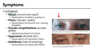 Horners Syndrome LO4  M1 Anatomy Learning Objectives [upl. by Anrahs]