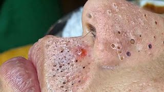 Big Cystic Acne Blackheads Extraction Blackheads amp Milia Whiteheads Removal Pimple Popping  313 [upl. by Nauh]