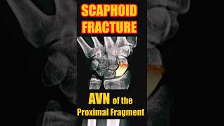 Fracture of the Scaphoid with Avascular Necrosis radiology doctor trauma [upl. by Nelia]