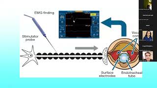 Intraoperative Nerve Monitoring IONM for Thyroid Surgery Dr Parthiban Velayutham [upl. by Fritze606]