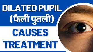 Dilated Pupil फैली हुई पुतली Causes and Treatment [upl. by Iemaj]