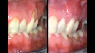 Treatment for Receding Gums [upl. by Bunde]