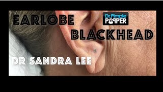 A nice earlobe blackhead extracted [upl. by Adlesirg]