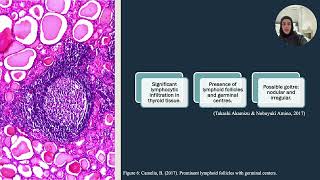 Pathophysiology and Pharmacology of Hashimoto’s Thyroiditis [upl. by Christan]