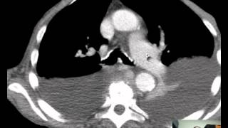 CT Mediastinum effusionsatelectasis Discussed by Radiologistmp4 [upl. by Nedaj]