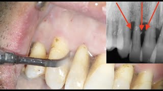 Igiene professionale scaling e root planing con strumenti sonici [upl. by Burley]