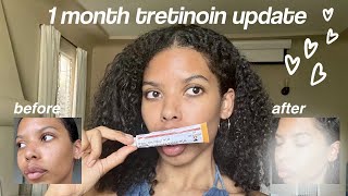 A Snippet of My Acne Journey Tretinoin 005 2021 Before amp After acne tretinoin shorts [upl. by Labinnah]