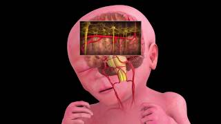 Periventricular Leukomalacia Explained by a Lawyer [upl. by Fortune337]