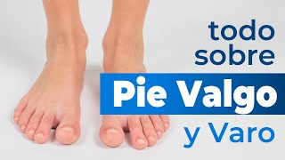 Pie valgo o varo y plantillas Pura [upl. by Sivrad]