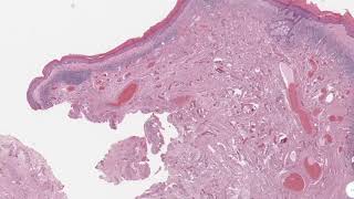 Dermatopathology Histopathology of Balanitis xerotica obliteransLichen sclerosis [upl. by Franza]