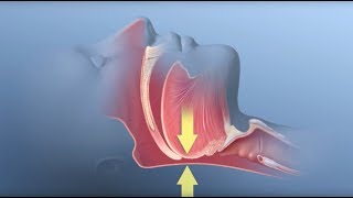 Obstructive Sleep Apnea  Mayo Clinic [upl. by Aremus376]