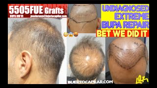 5505GraftsLong term control Undiagnosed BUPA extreme repair 3HT wBHT Below TDC Scar 20922018 [upl. by Elbert]