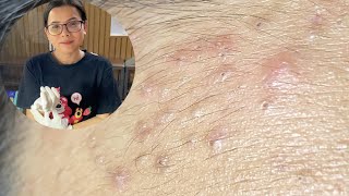 Acne Treatment Huong Da Nang  2024 blackheads 700 [upl. by Ydnam]