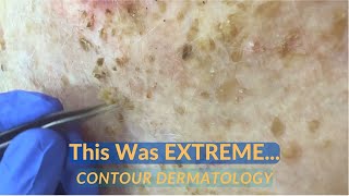 SEVERE Debridement of Seborrheic Dermatitis Scale  CONTOUR DERMATOLOGY [upl. by Nnarefinnej626]