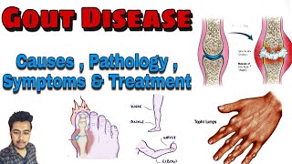 Gout Disease  Cause  Pathology  Symptoms  Treatment  Arthritis Nursing Lecture in Hindi MSN 1 [upl. by Zane]