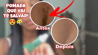 POMADA PARA ESPINHAS ACNE QUE SALVA EM POUCOS DIAS 😍 [upl. by Elnora]