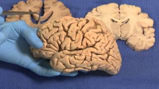 Limbic Neuroanatomy Video Lab  Brain Dissections [upl. by Renraw]