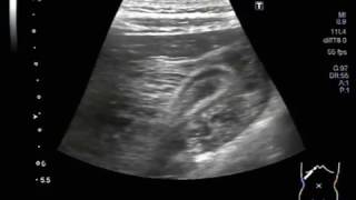 Ultrasound Video showing characteristic quotlayeringquot of Gall Bladder walls [upl. by Joy451]