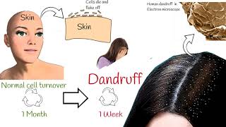 Dandruff explained in under 2 minutes Dandruff Causes and Treatment [upl. by Bradly]