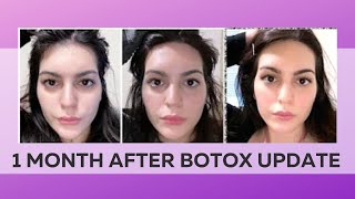 Botox Brow Lift Update  This is what happens after botox [upl. by Shornick]