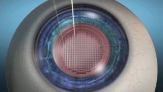 Laser Cataract Femtosecond Animation [upl. by Kimura]