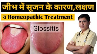 Glossitis  जीभ में सुजन के कारण लक्षण व् इलाज  Glossitis Homeopathic Treatment  Glossitis Tongue [upl. by Demetre]