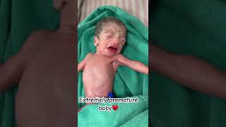 Extremely low birth weight baby born with 950garm ankur maitrika hospital 🏥♥️ [upl. by Artek]