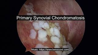 Primary synovial chondromatosis [upl. by January]