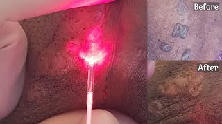 Warts Removal With Advanced Laser Treatment  Laven Clinic Group [upl. by Allie801]