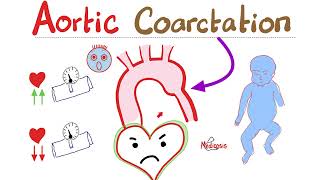 Coarctation of the Aorta  Cardiology Series  Types Symptoms Signs Diagnosis amp Treatment [upl. by Merp722]