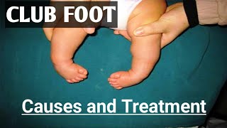 Clubfoot Deformity Clubfoot Physiotherapy How to treat ClubFoot [upl. by Ahsiuqat547]