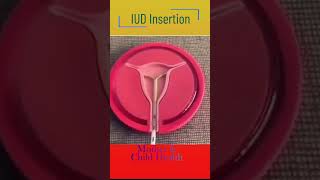 IUD insertion [upl. by Asoramla560]