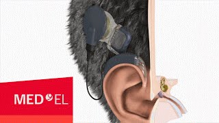 The MAESTRO Cochlear Implant System from MEDEL with OPUS2 XS  USA [upl. by Battiste]