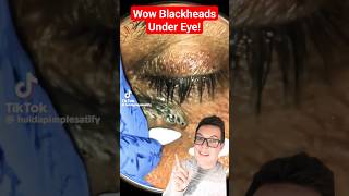 Blackheads Extractions on ¨D¨ [upl. by Iman]